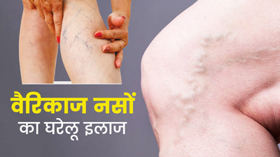 वैरिकोज वेन्स (उभरी नीली नसों) को ठीक करने के लिए घरेलू उपचार, जानें डॉक्टर से
